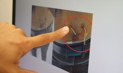 Ağrıları geçsin diye belinden çamaşır ipi geçirmişler