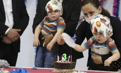 Ameliyatla ayrılan siyam ikizlerine doğum günü sürprizi