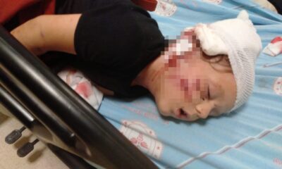 Antalya’da köpeğin saldırısına uğrayan 3,5 yaşındaki çocuk, ölümden döndü