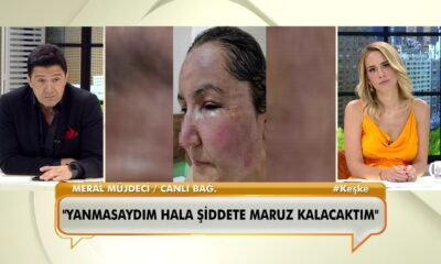Canlı yayında bağlanan kadın, eşinin kendisini kızgın yağ ile yaktığını söyledi