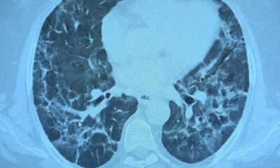 Korona virüs geçiren hastalarda yeni klinik bulgular: “Uzamış Covid ve post Covid”