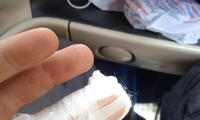 Parmağındaki 3 santimetrelik vidayla hastaneye koştu