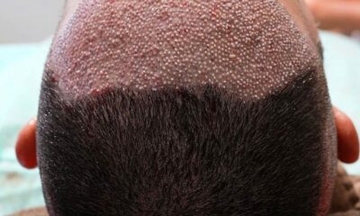 Saç ekiminde fiyatı kök miktarı belirliyor