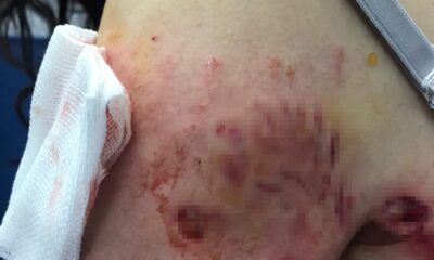 Sokak köpekleri genç kıza saldırdı