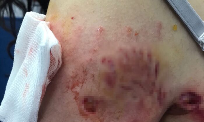 Sokak köpekleri genç kıza saldırdı