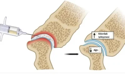 Dize Eksozom Tedavisi Sonrası Öneriler
